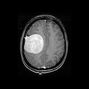 شناسایی و دسته بندی تومور مغز در MRI با استفاده از متلب و پردازش تصویر